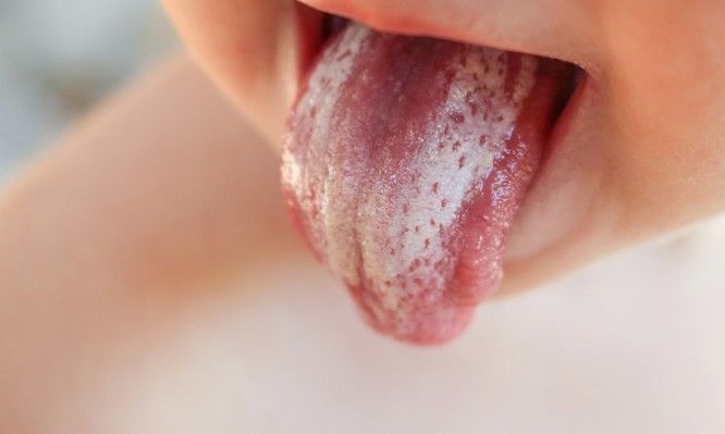 Τι σημαίνει η λευκή γλώσσα στο παιδί
