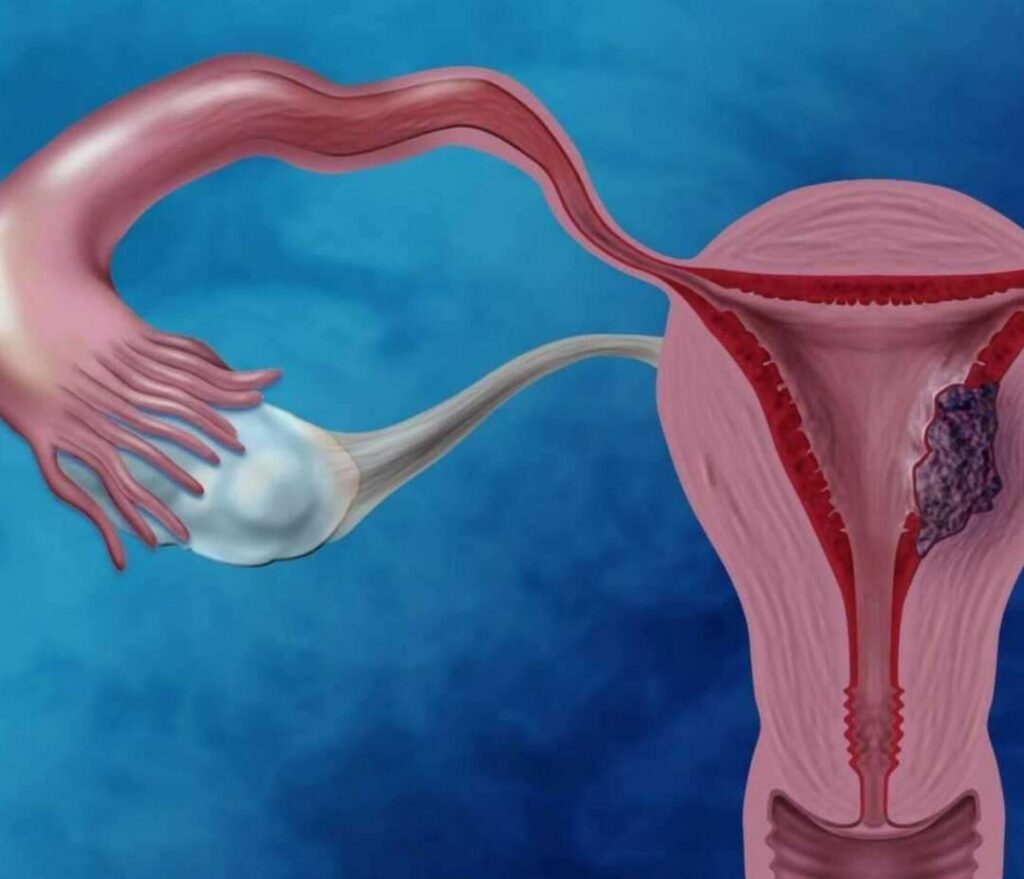 Ορώδης καρκίνος του ενδομητρίου-Νεότερες εξελίξεις υπόσχονται σημαντικά καλύτερα αποτελέσματα