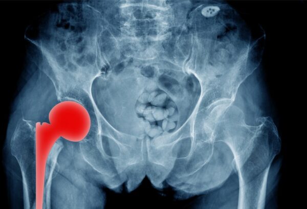 SuperPATH: Αποτελεσματική τεχνική για ολική αρθροπλαστική ισχίου