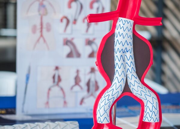 Aνεύρυσμα κοιλιακής αορτής: Παράγοντες κινδύνου  και θεραπεία