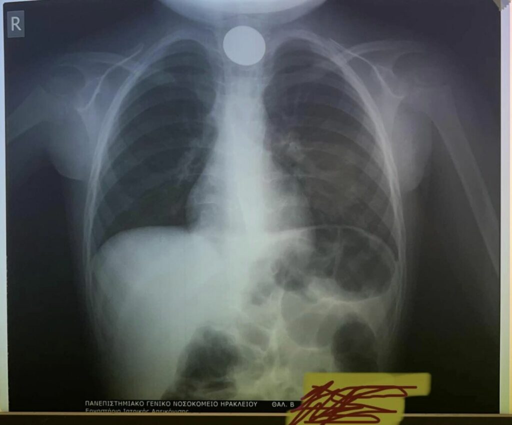 Αγωνία για 4χρονο στην Κρήτη που κατάπιε κέρμα και στάθηκε στον λαιμό του – Δείτε την σοκαριστική ακτινογραφία