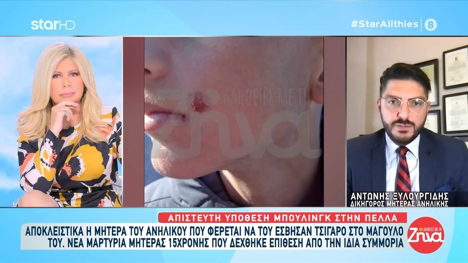 Απίστευτη υπόθεση bullying στην Πέλλα-Ξεσπά η μητέρα 14χρονου που φέρεται να του έσβησαν τσιγάρο στο μάγουλο: Το παιδί φοβάται να πάει στο σχολείο…