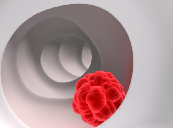 Ο ρόλος της τεχνητής νοημοσύνης στην κολονοσκόπηση