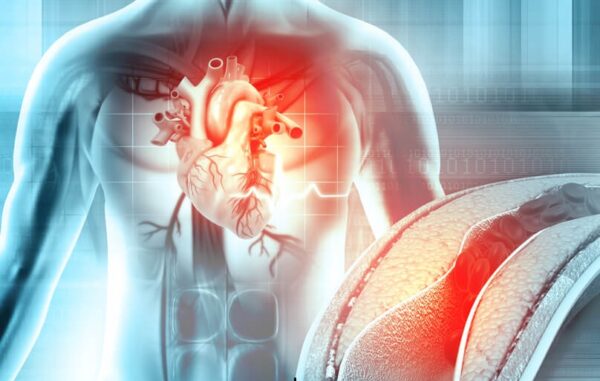 Στεφανιαίες βλάβες: Νέα αναίμακτη μέθοδος εκτίμησης της βαρύτητάς τους