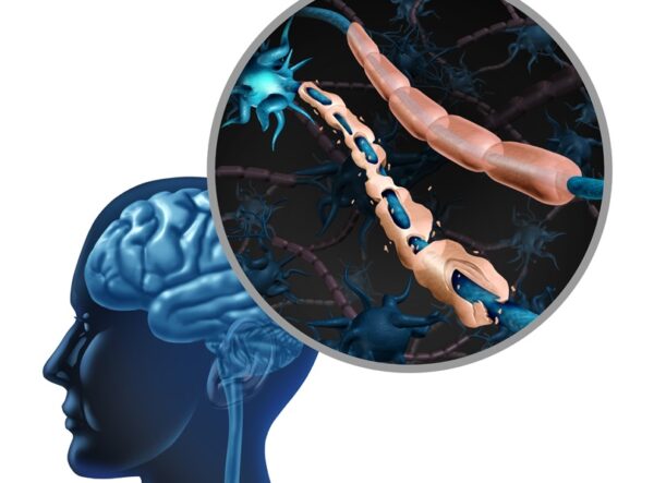 30 Μαΐου Παγκόσμια ημέραγια τη Σκλήρυνση Κατά Πλάκας -Εξελίξεις στη θεραπευτική αντιμετώπιση της