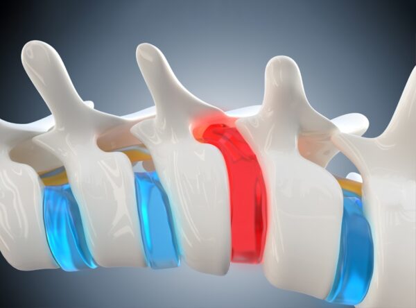 Κήλη Μεσοσπονδύλιου Δίσκου: Συμπτώματα και αντιμετώπιση