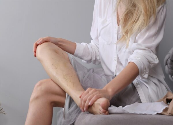 Φλεβική ανεπάρκεια και κιρσοί: Ποιοι κινδυνεύουν περισσότερο; -Ενοχοποιητικοί παράγοντες και σύγχρονη θεραπεία