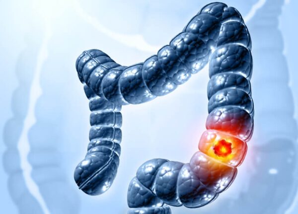 Καρκίνος του παχέος εντέρου: Ποια συμπτώματα προειδοποιούν;