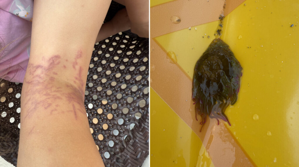 Περιπέτεια για 6χρονη στην Κέα: Την τσίμπησε θαλάσσια ανεμώνη, γύρισε εσπευσμένα στην Αθήνα για νοσηλεία – Δείτε φωτογραφίες