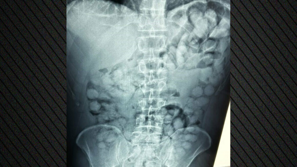 Συνελήφθη άνδρας στο Ελ. Βενιζέλος που είχε καταπιεί 100 συσκευασίες κοκαΐνης – Δείτε φωτογραφίες