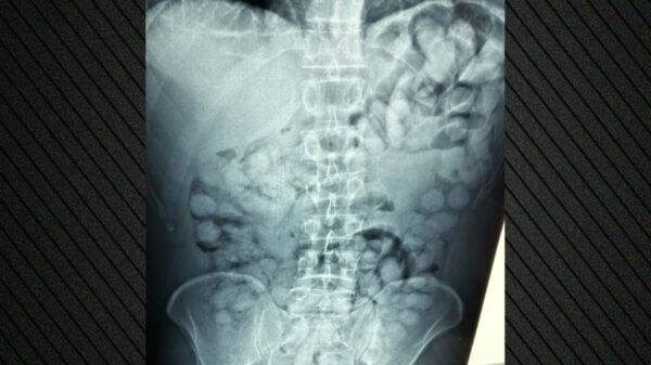 Συνελήφθη άνδρας στο Ελ. Βενιζέλος που είχε καταπιεί 100 συσκευασίες κοκαΐνης – Δείτε φωτογραφίες