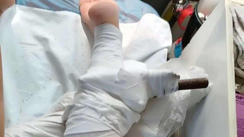 Σοκ: Ομπρέλα καρφώθηκε στο πόδι 26χρονης – Φυσούσαν θυελλώδεις άνεμοι