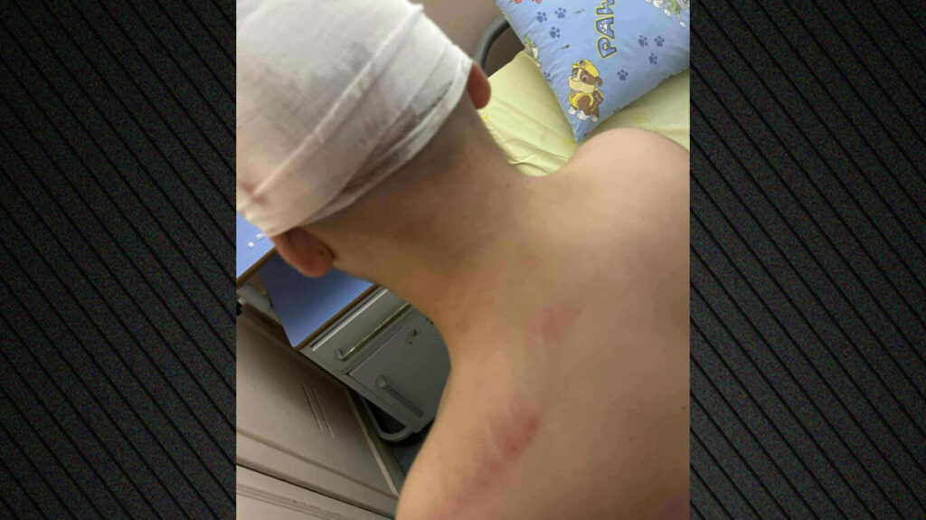 Για απόπειρα ανθρωποκτονίας κατηγορείται ο 18χρονος που συνελήφθη για τον άγριο ξυλοδαρμό 13χρονου στη Θεσσαλονίκη