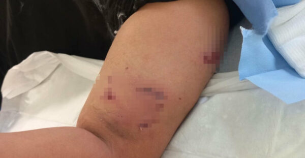 Επίθεση σκύλου σε 12χρονο έξω από σχολείο στο Πέραμα – «Ζητώ την τιμωρία του ιδιοκτήτη» λέει η μητέρα του