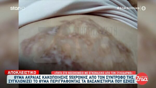 Θύμα ακραίας ενδοοικογενειακής βίας: «Έσβηνε τσιγάρα πάνω μου – Μου έκαιγε το δέρμα στο καλοριφέρ»