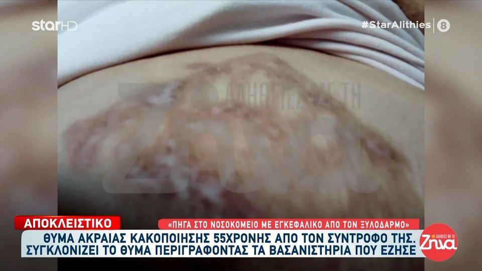 Θύμα ακραίας ενδοοικογενειακής βίας: «Έσβηνε τσιγάρα πάνω μου – Μου έκαιγε το δέρμα στο καλοριφέρ»