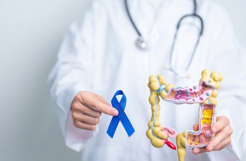 Καρκίνος παχέος εντέρου: Γιατί αυξάνεται στα άτομα κάτω των 50;