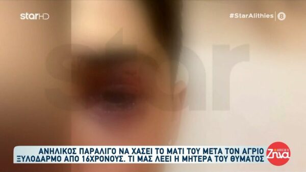 Ιωάννινα-Σοκάρει η μητέρα του 16χρονου που δέχτηκε επίθεση: Του έκαναν 17 ράμματα στο μάτι…περιμένουμε πως θα εξελιχθεί. Θα χρειαστεί και άλλο χειρουργείο…
