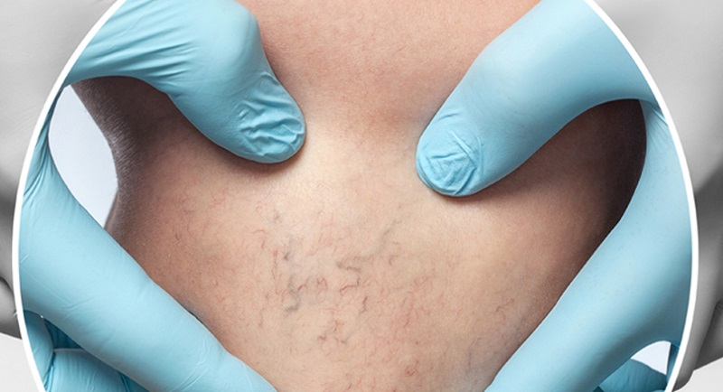 Σκληροθεραπεία: Μια αξιόπιστη λύση για την εξάλειψη των ευρυαγγειών