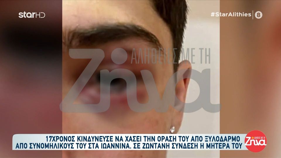 Συγκλονίζει η μητέρα του 17χρονου που κινδύνευσε να χάσει την όρασή του από ξυλοδαρμό: Πήγαν να σκοτώσουν το παιδί μου…