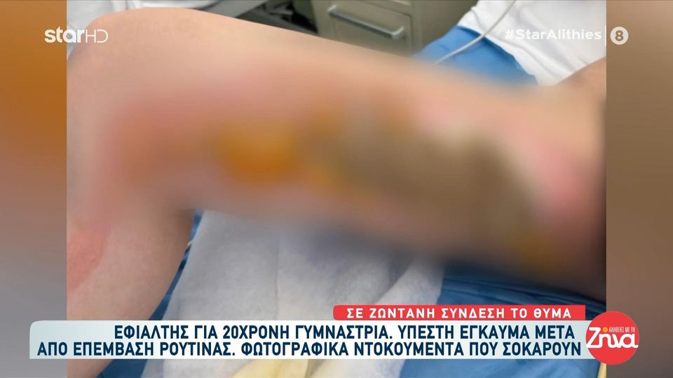 Εφιάλτης για 20χρονη γυμνάστρια: Υπέστη έγκαυμα μετά από επέμβαση ρουτίνας